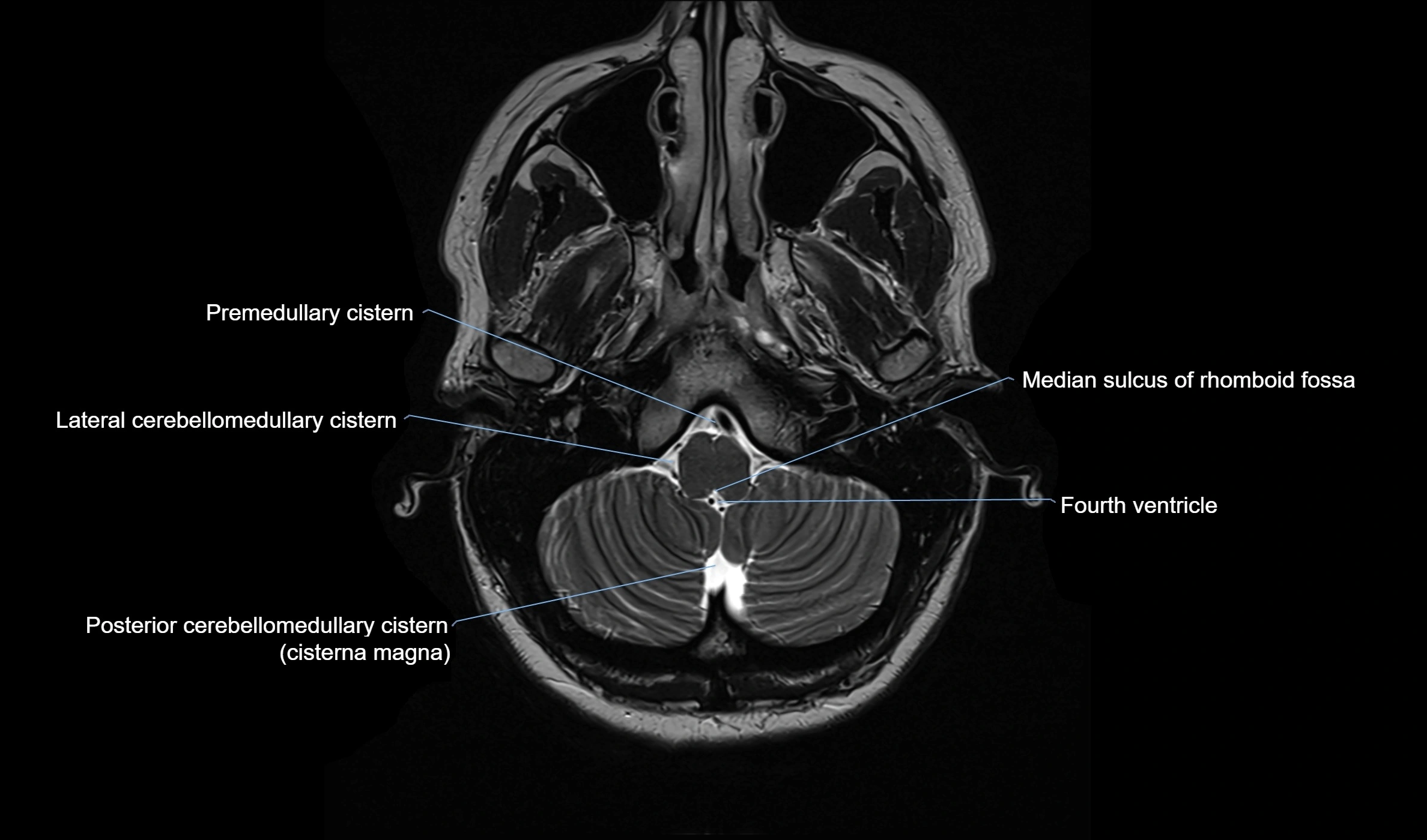 Brain cisterns  and ventricles  axial anatomy 3T MRI image-img-00001-00006.webp
